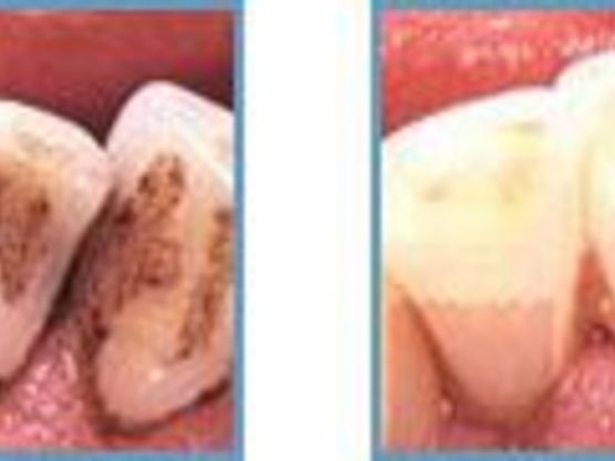 Schadet die Zahnsteinentfernung der Zähne?